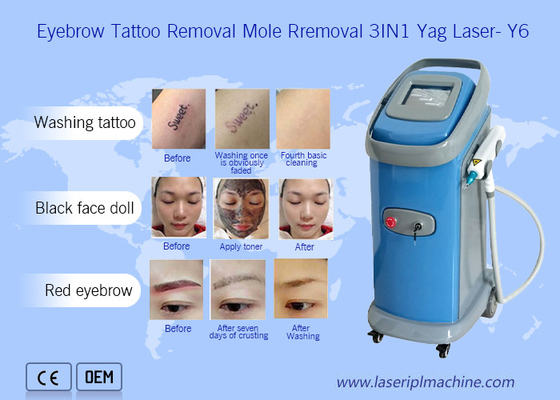 1064nm 532nm Nd Yag লেজার ট্যাটু অপসারণ মেশিন Dermatology