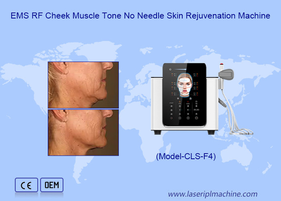 মুখের wrinkles হ্রাস HiEMT মেশিন সঙ্গে 200μs পালস এবং Biphasic তরঙ্গ আকৃতি